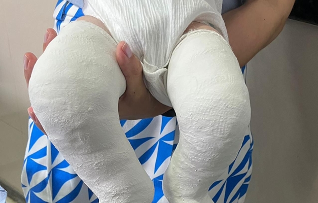  HMAP é referência em cirurgia e tratamento de “pé torto” para crianças