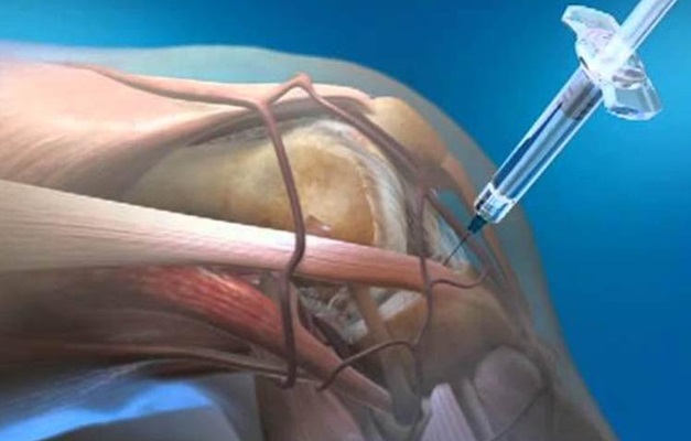 Ácido hialurônico é opção para tratar a artrose do joelho