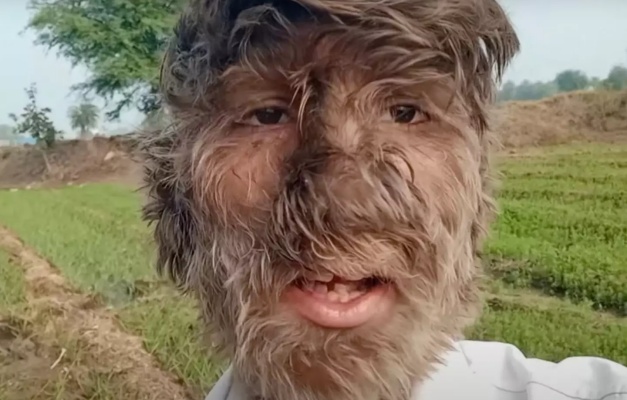 Adolescente indiano entra para o 'Guinness' por quebrar recorde de rosto mais peludo