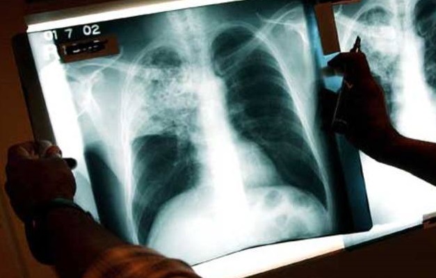 Brasil é 16º em lista de países com mais casos de tuberculose