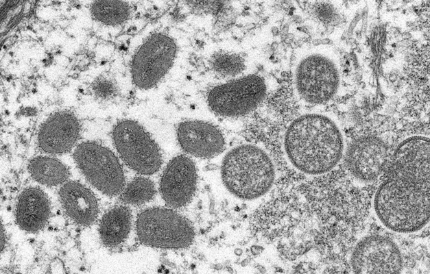 Brasil registra terceiro caso de varíola dos macacos
