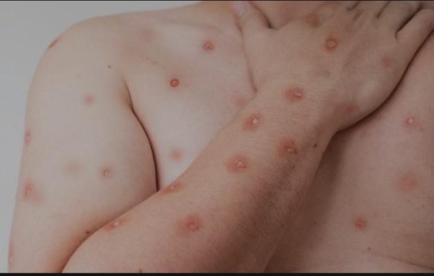 Confirmado primeiro caso de nova cepa de mpox no Brasil