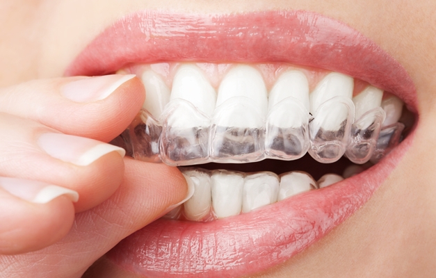 Dez coisas que você precisa saber sobre clareamento dental