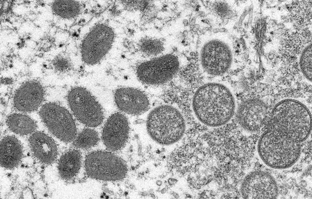 Goiás confirma dois primeiros casos de varíola dos macacos 