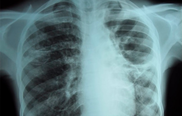 Goiás é o segundo com menor incidência de tuberculose no país