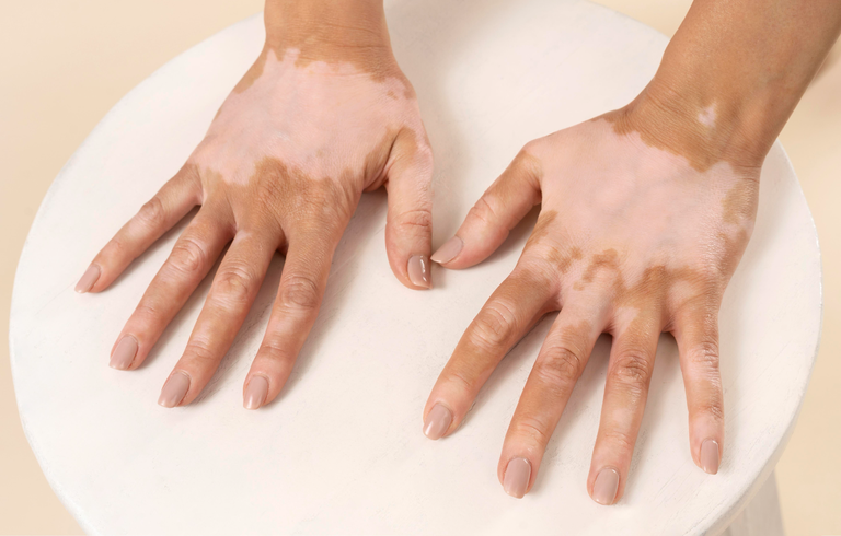 Hospital das Clínicas oferece tratamento com fototerapia para vitiligo