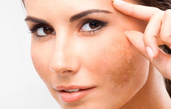 Melasma: tratamentos se mostram cada vez mais eficazes