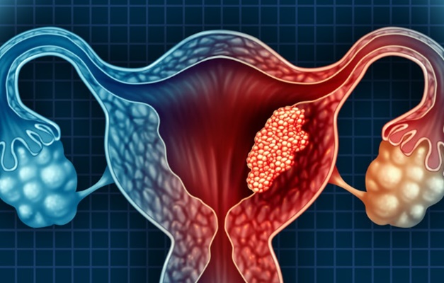 Ministério da Saúde: endometriose atinge 1 a cada 10 mulheres no Brasil