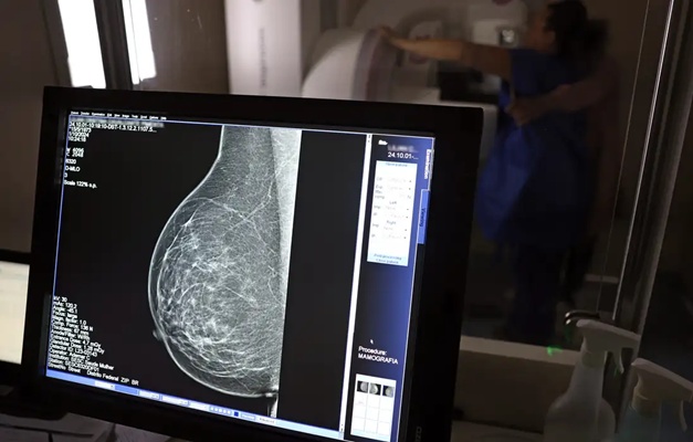 Ministério da Saúde passa a recomendar mamografia a partir dos 40 anos