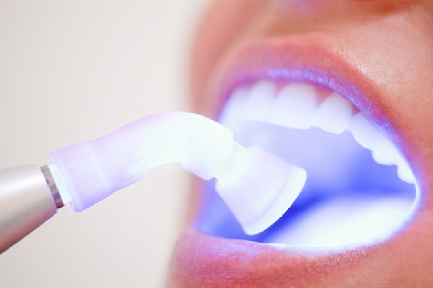 Mitos e verdades sobre clareamento dental