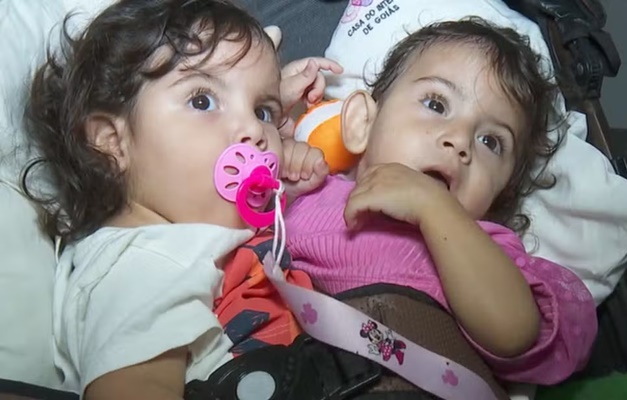 Morre uma das siamesas de São Paulo que foram separadas em Goiás
