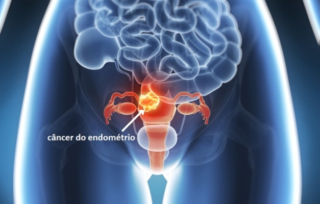 Oncologista explica quando suspeitar do câncer de endométrio