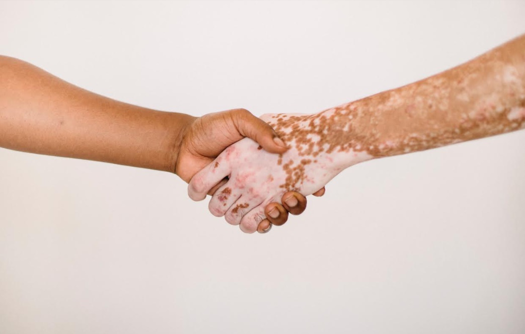 Planta do Cerrado é base de pesquisa para tratamento natural de vitiligo