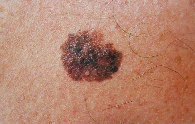 Saiba quais os sinais que indicam o câncer de pele