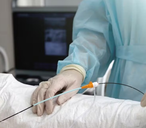 Ablação: entenda o procedimento utilizado para tratar arritmia de Caiado 