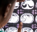 AVC mata uma pessoa a cada seis minutos no Brasil
