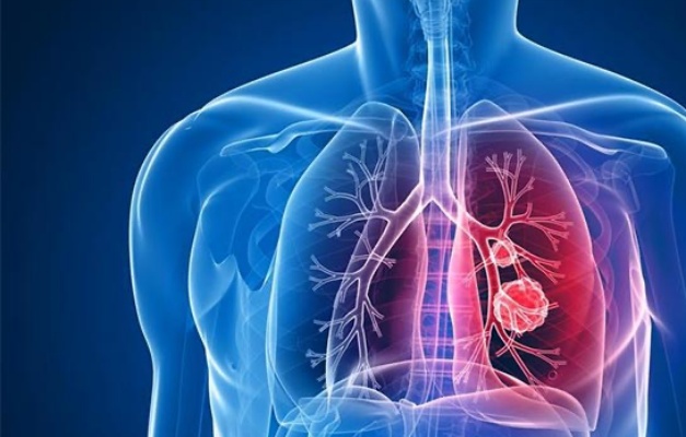 Tuberculose mata mais de 1,2 milhão de pessoas por ano, aponta OMS